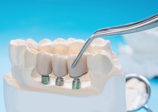 Dental Implants