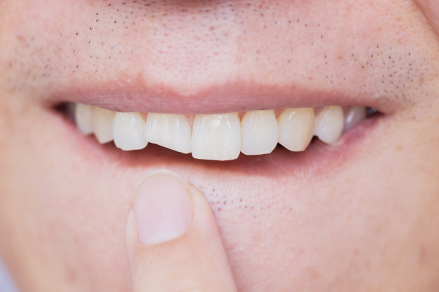Cracked Tooth Syndrome : How to detect it