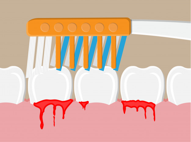 How to prevent bleeding gums