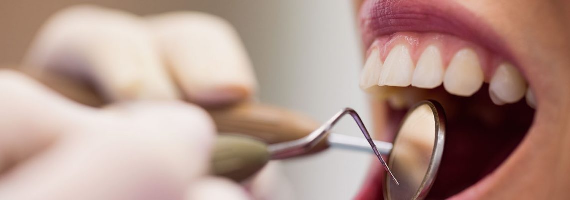 Tooth scaling : Do you need it?